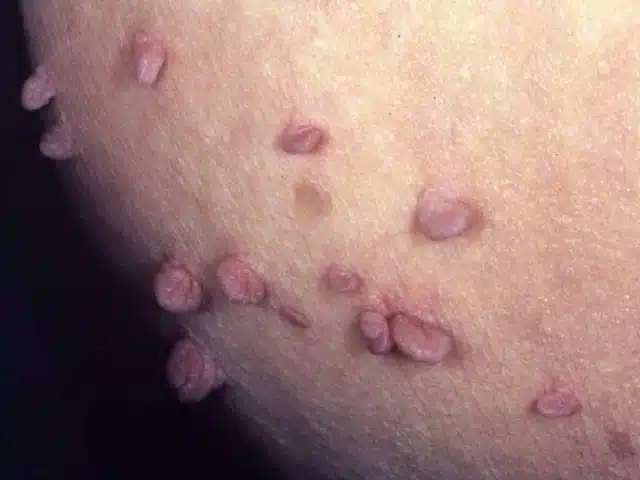 عکس زگیل تناسلی